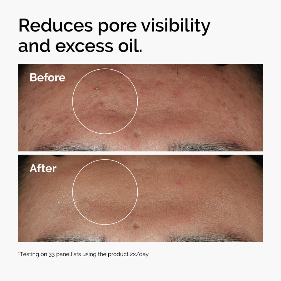 niacinamide-10-zinc-1-o0 ord-niacinamide-zinc-blemish-serum-before-after-pores.jpg