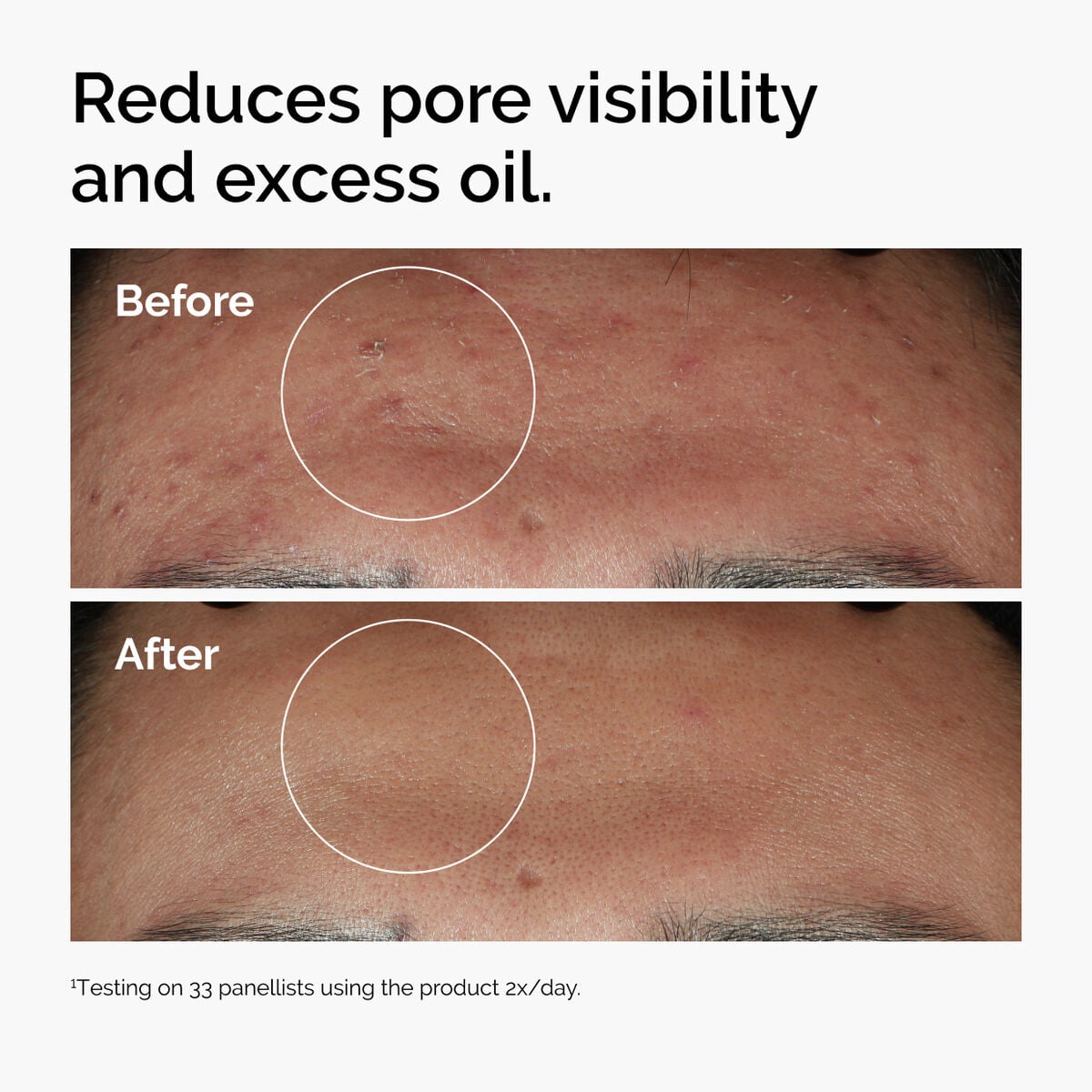 niacinamide-10-zinc-1-o0 ord-niacinamide-zinc-blemish-serum-before-after-pores.jpg