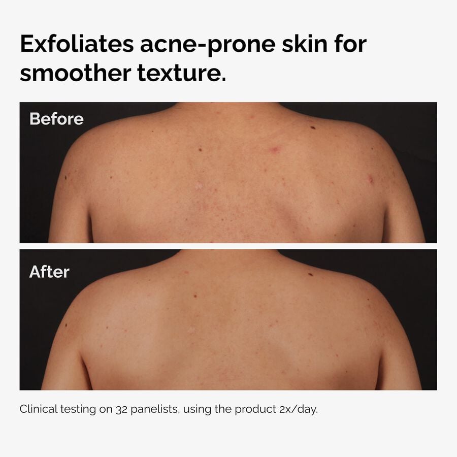 the-body-care-collection-a1 ord-salicylic-acid-body-serum-before-after-graphic-NA.jpg