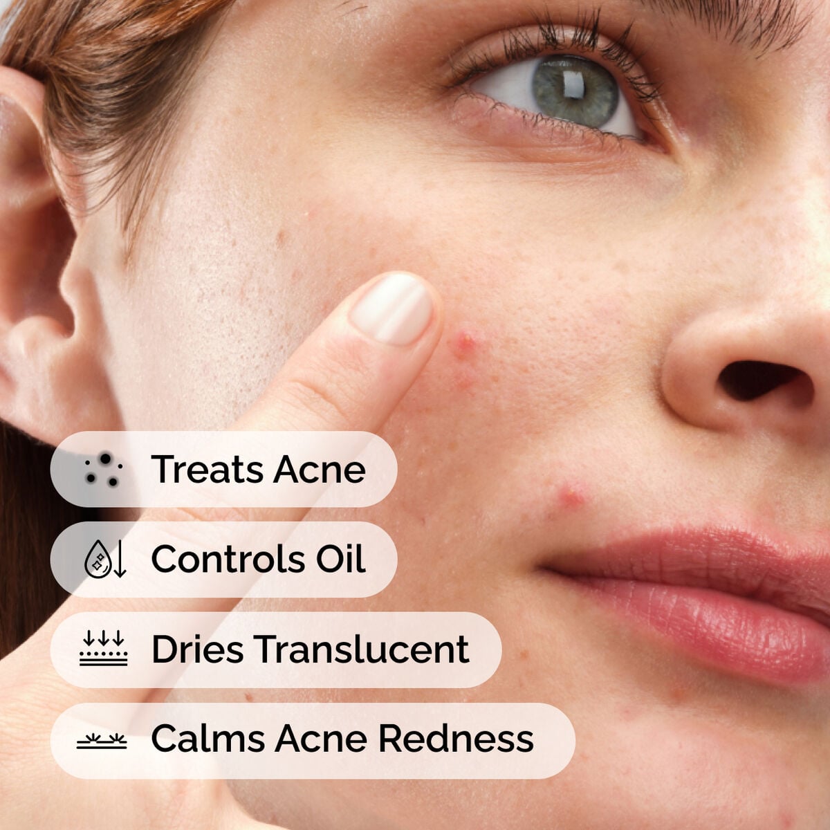 sulfur-10-powder-to-cream-concentrate-t7 ord-sulfur-10pct-powder-to-cream-concentrate-model-application-with-benefits-acne.jpg