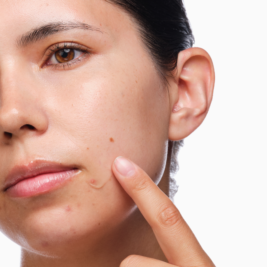 the-acne-set-s6 rdn-the-acne-set-application.png